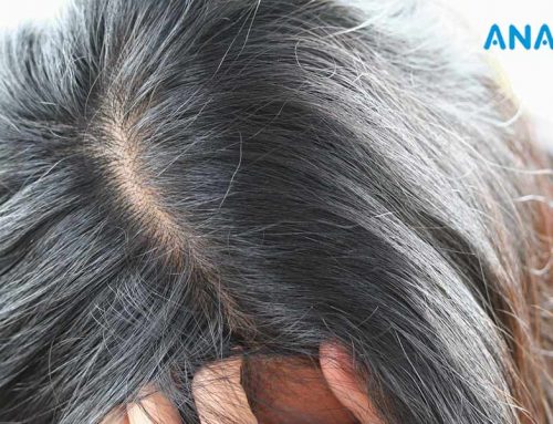 Les Pellicules Causent-elles la Perte de Cheveux?